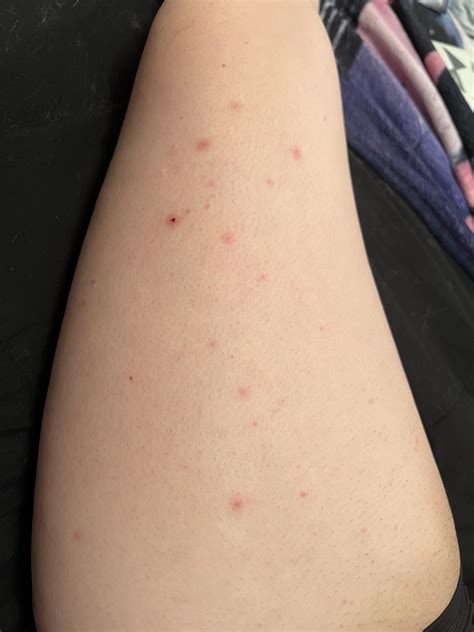 I’ve had these pimples/bumps on my leg for a very long time… I’d say it’s actually been months ...