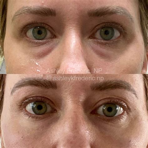 Say goodbye to tired eyes!😴 Tear trough (under eye) filler is used to replace volume loss ...
