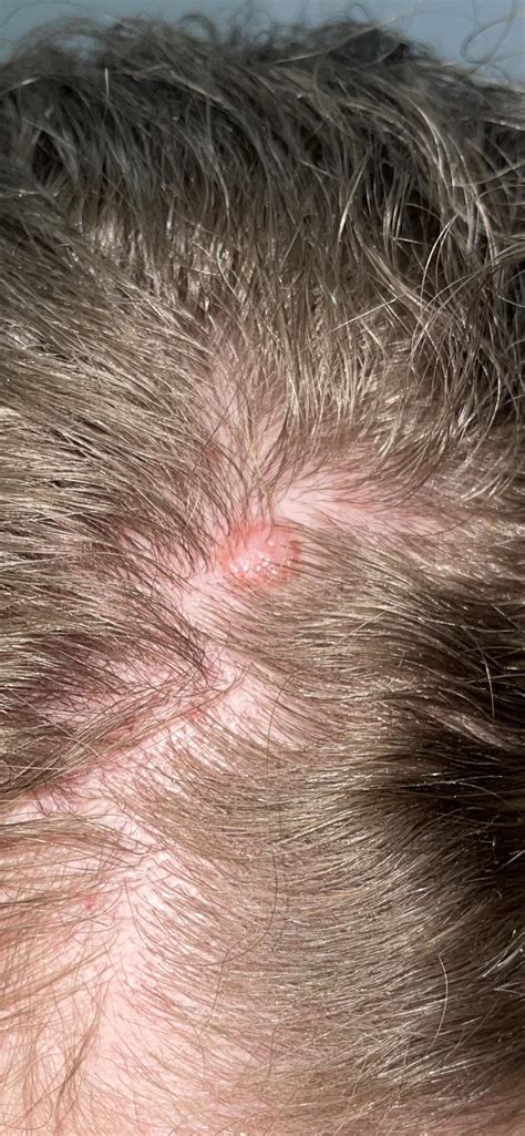 bump on scalp : r/SkincareAddicts