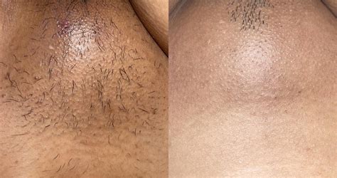 Laser Hair Removal Before And After Brazilian