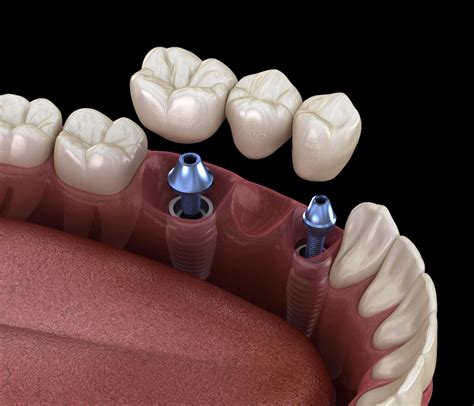 Dental Implant-Crowns In Redwood City | Dental Implant Crowns Near You