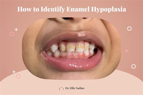 Enamel Hypoplasia Ppt | Enamel Hypoplasia and Hypomineralization – MRQO