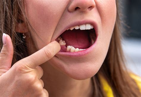 What To Eat After A Tooth Extraction: Best Foods & Recovery Tips