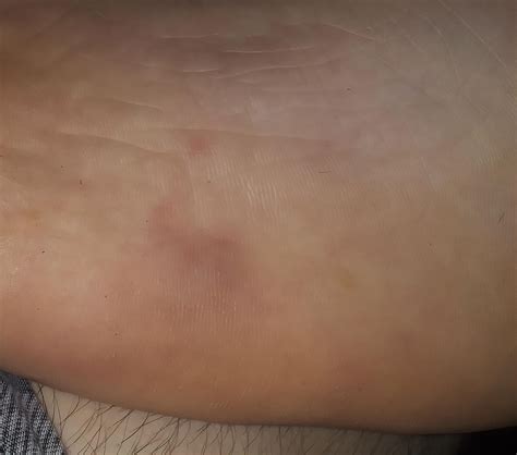Bruise/Swelling in Outer Foot - Any Idea What It Is? : r/lupus