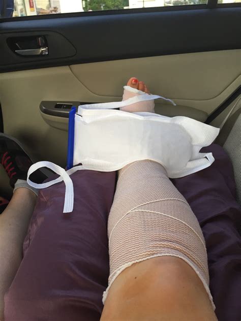 Broken Foot Cast