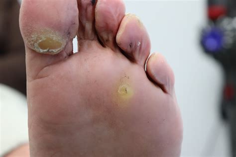 Infected Corn On Bottom Of Foot Clearance | emergencydentistry.com