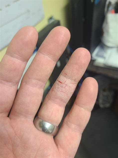 I have dry cracking skin that forms on only one finger. I tried cortisone cream (otc) and with ...
