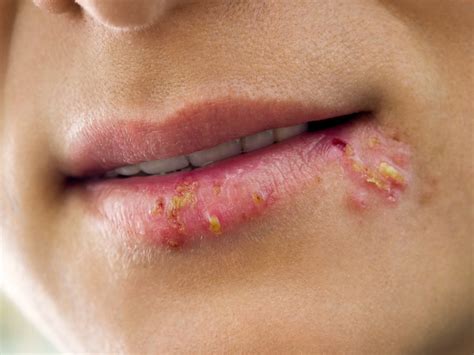Why Do Fever Blisters Appear On Lips | Lipstutorial.org