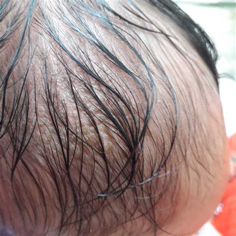 Soft Spot On Baby Head