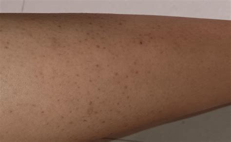 how do I get rid of scars from popping my keratosis pilaris? : r/keratosis