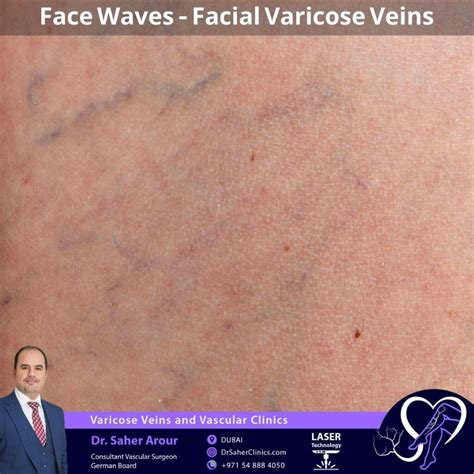 Face Waves - Facial Varicose Veins - Dr. Saher Arour