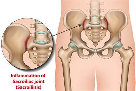 Sacroiliac Joint Dysfunction Causes, Symptoms & Treatment | Advanced Surgery Center