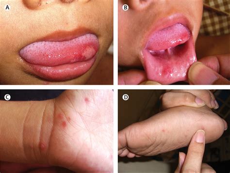 Clinical features, diagnosis, and management of enterovirus 71 - The ...