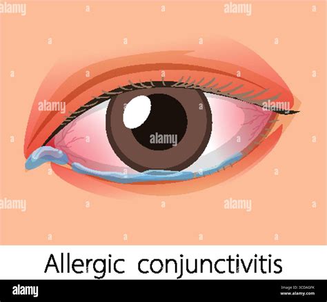 Vector illustration of a human eye showing redness, swelling, and watery discharge, representing ...