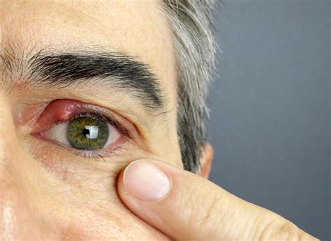 Por qué salen los orzuelos por estrés: causas y tratamiento