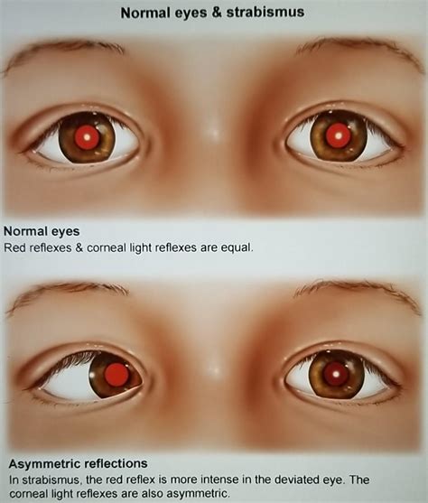 Corneal Light Reflex