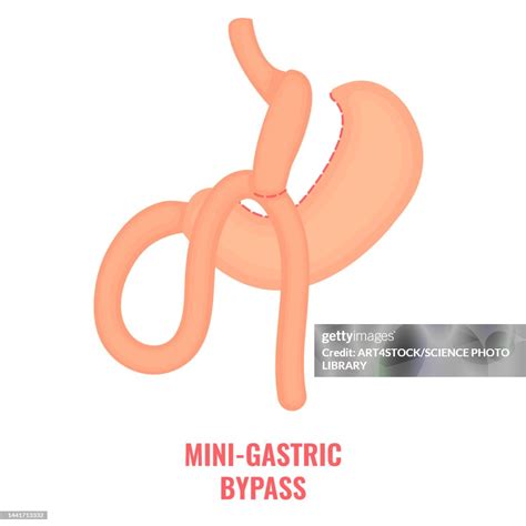 Mini Gastric Bypass Bariatric Surgery Illustration High-Res Vector Graphic - Getty Images