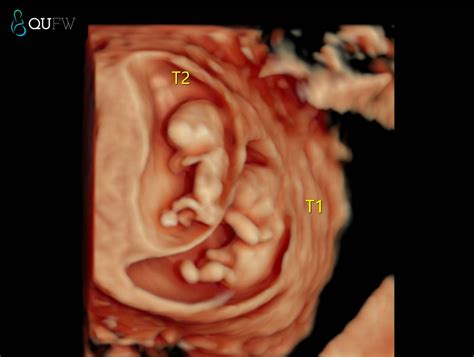 Multiple Pregnancy Scans