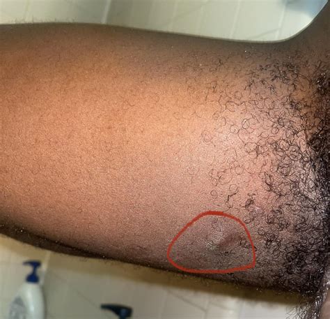 Ingrown Hair Hard Lump