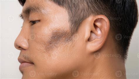 close-up of melasma on cheekbone with gray-brown patch, skin ...