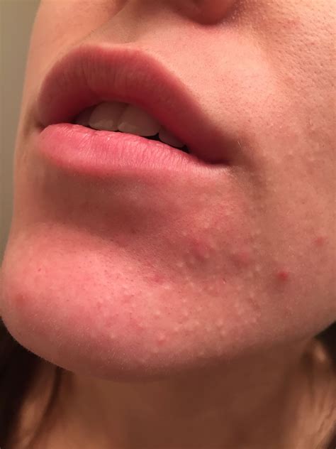 How to get rid of acne around mouth – Artofit