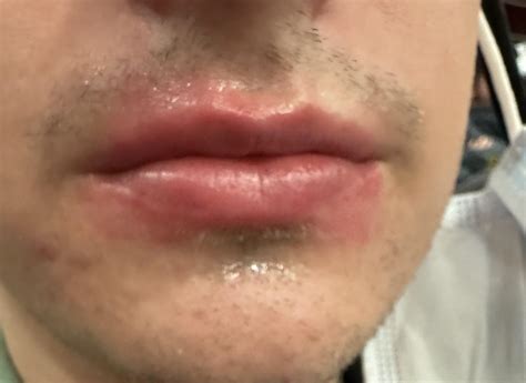 Eczema On And Around Lips at Johanna Engles blog