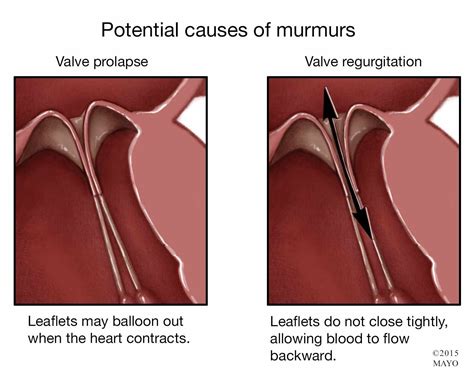 A Heart Murmur Can be Innocent or Serious - Mayo Clinic News Network