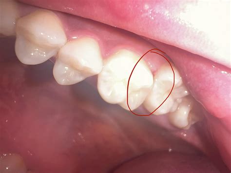 Pain in gums when eating : r/askdentists