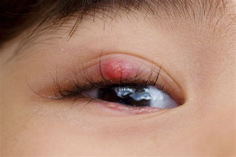 How To Treat A Stye In The Eye Under Eyelid Avoid Stye, Dry Eye & Red