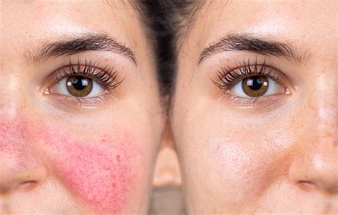 Best Ingredients to Treat Rosacea & Calm Sensitive Skin - skins.