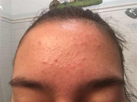 Moderate Acne Forehead