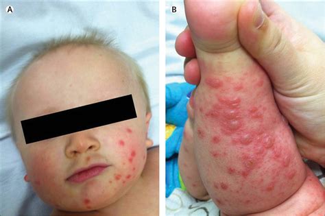 Atypical hand, foot, and mouth disease: a vesiculobullous eruption caused by Coxsackie virus A6 ...