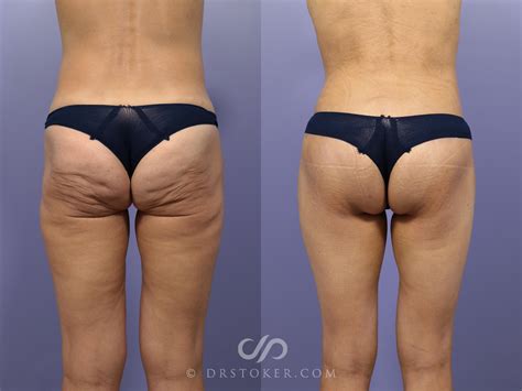 Plastic Surgery Before And After Buttocks Brazilian Butt Lift At