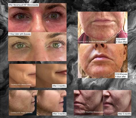 EXOSOME FACIAL in Prosper TX - Lotus Med Spa