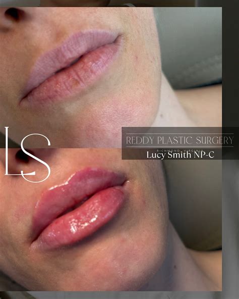 Reddy Plastic Surgery (@reddyplasticsurgery) • Instagram photos and videos