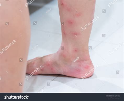 14,958 Ant Bites Images, Stock Photos & Vectors | Shutterstock
