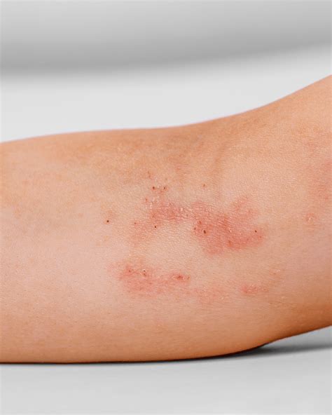 Eczema Clinic News, Tips, and Information