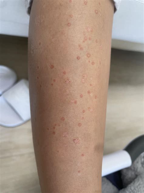 What could this rash be? Appeared about 4 weeks postpartum. Occurred ...