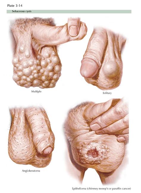 CYSTS AND CANCER OF THE SCROTUM - pediagenosis
