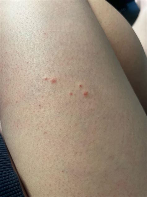 Cluster of itchy bumps on leg (F20) : r/DermatologyQuestions