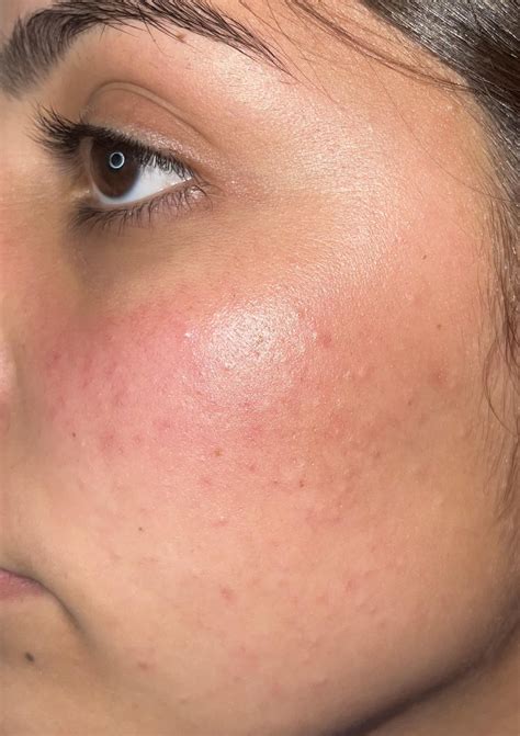 Closed Comedones or Fungal Acne?? : r/Skincare_Addiction