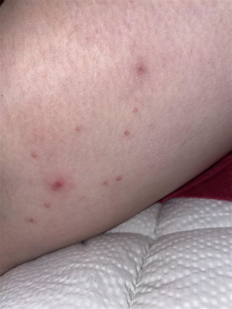 Red bumps on inner thigh : r/Dermatology