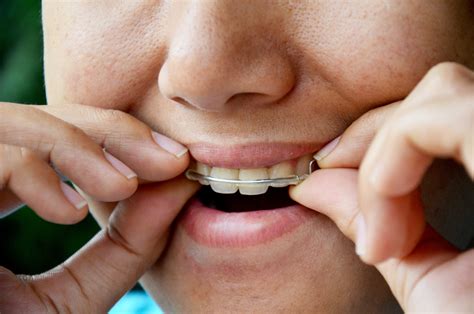 How Long to Wear Retainer After Braces ⋆ ctf.bnsf.com