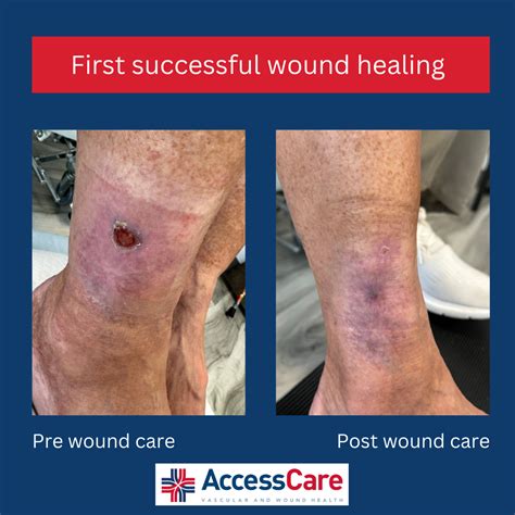 First successful wound healed!!!! - BEVSA - Buffalo Endovascular & Vascular Surgical Associates ...