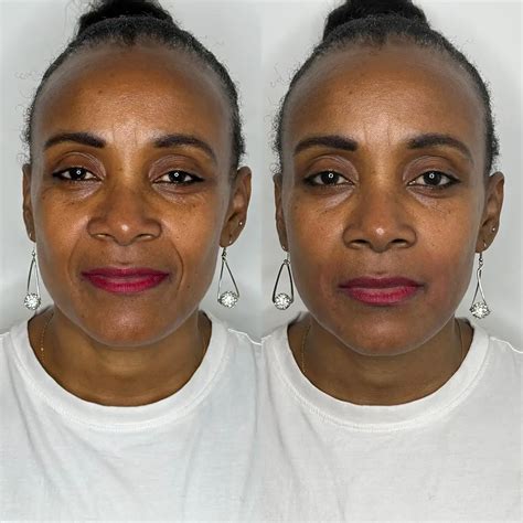 Marionette Lines Treating Marionette Lines Facial Acupuncture