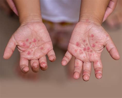 A Surge in Hand, Foot, and Mouth Disease: What Every Parent Should Know