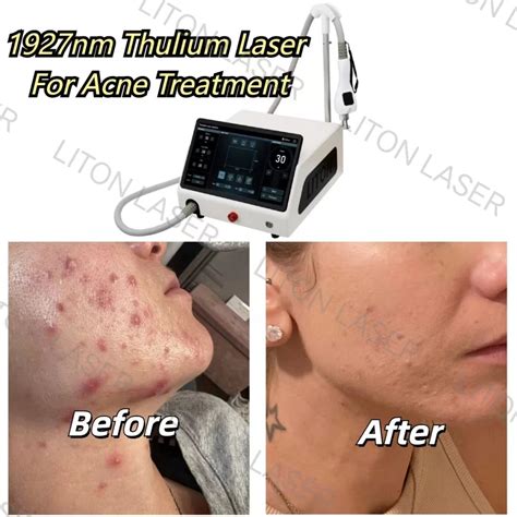 New Beauty Technology: 1550/1927 Thulium Erbium Fiber Laser