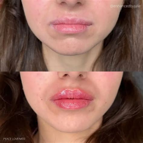 Lip Filler Before and After - Before After Journey