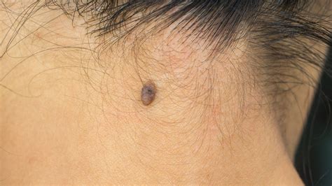 Oval Lesions On Face