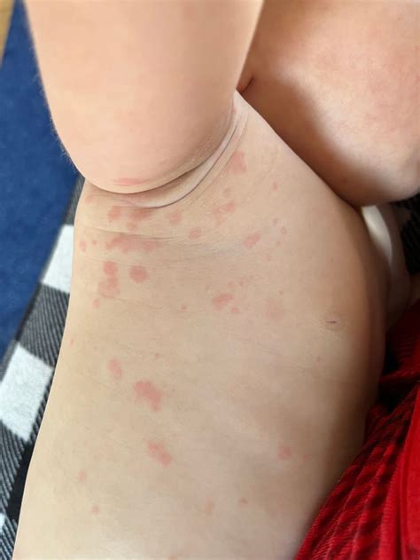 Amoxicillin Rash Face